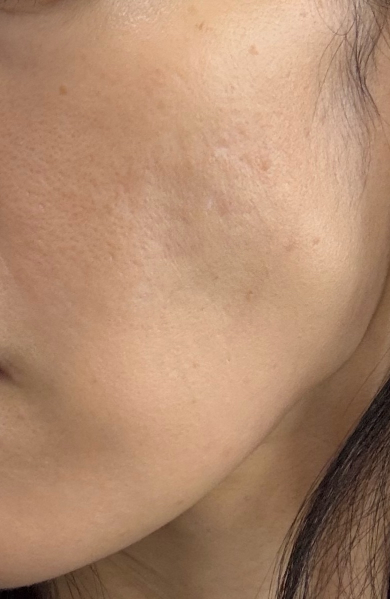 再来OK】コラーゲンピール＋イオン導入 | シティタワー新宿クリニック