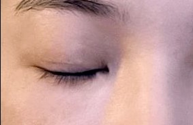 after photo: 눈밑필러