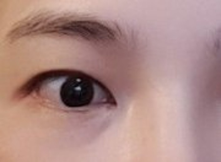 before photo: 눈밑필러