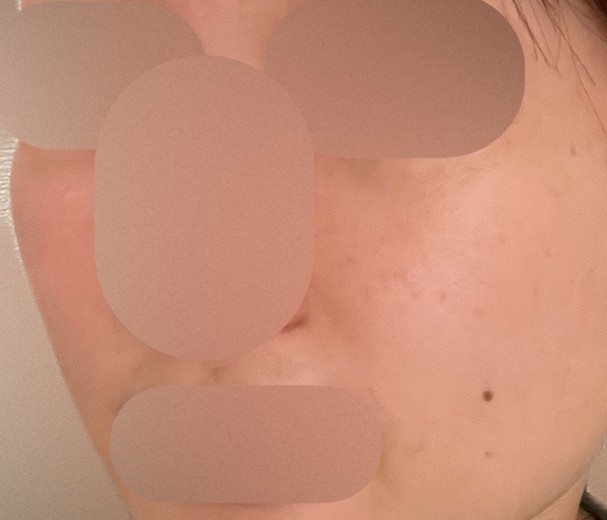after photo: ハイドラフェイシャル