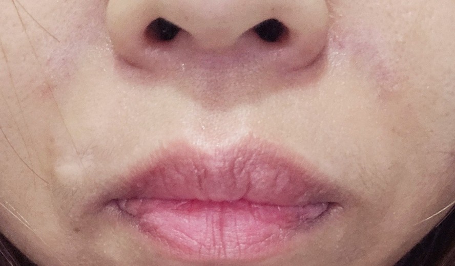 after photo: CO2레이저, PRP피부재생술