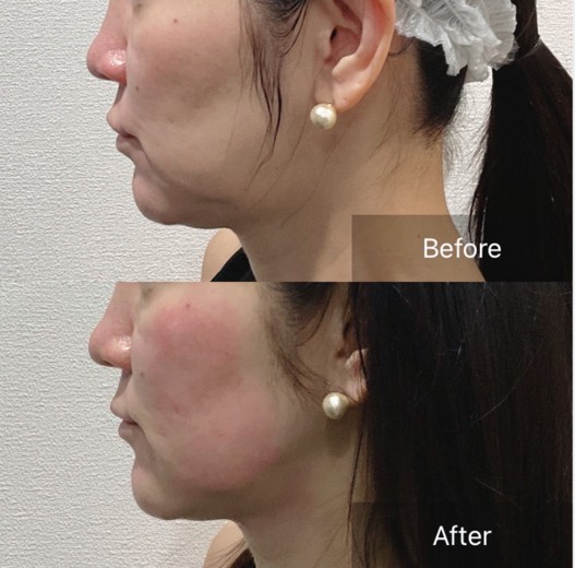 before photo: チタニウムリフト