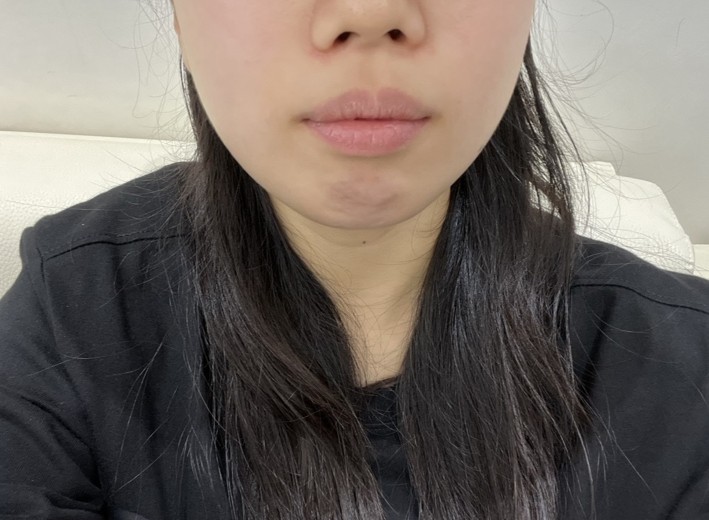 before photo: 입술필러