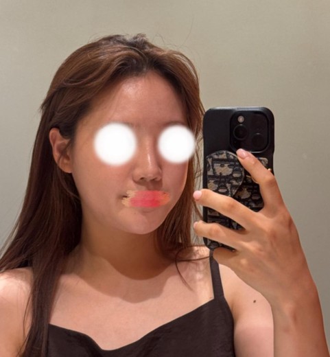 before photo: 얼굴지방분해주사