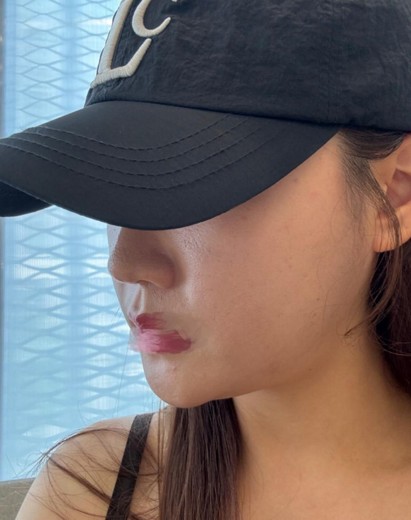 before photo: 얼굴지방분해주사