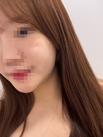 before photo: 얼굴지방분해주사