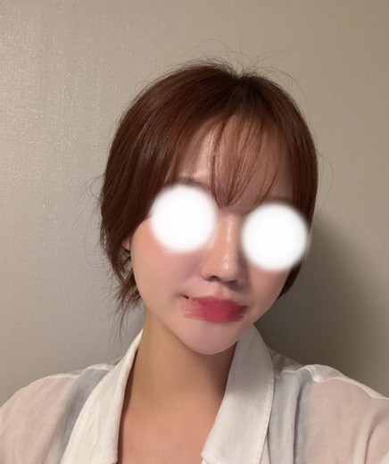 after photo: 얼굴지방분해주사