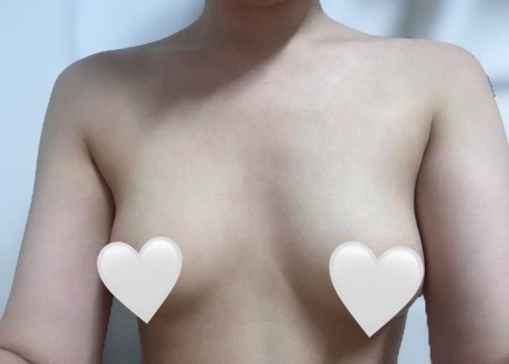 before photo: 가슴(보형물)