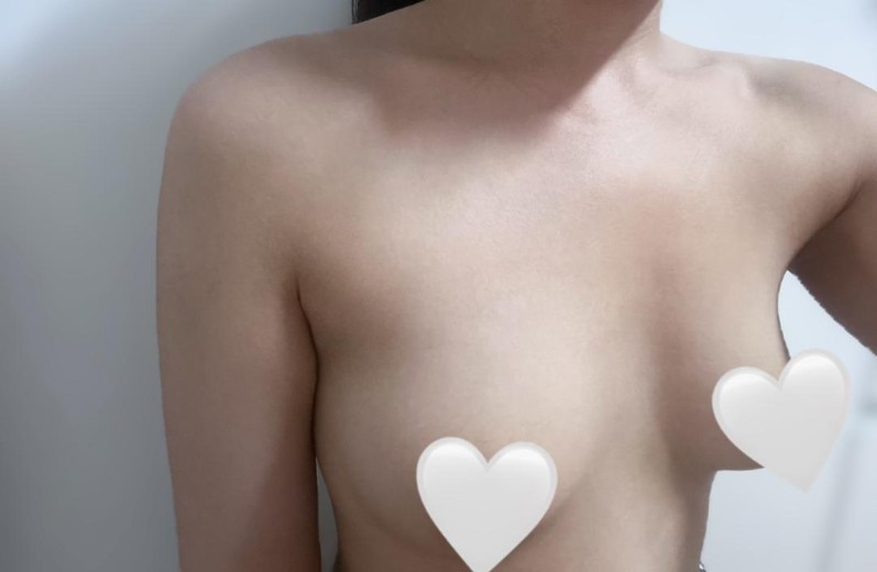 before photo: 가슴(보형물)