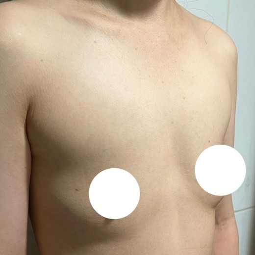 before photo: 가슴(보형물)