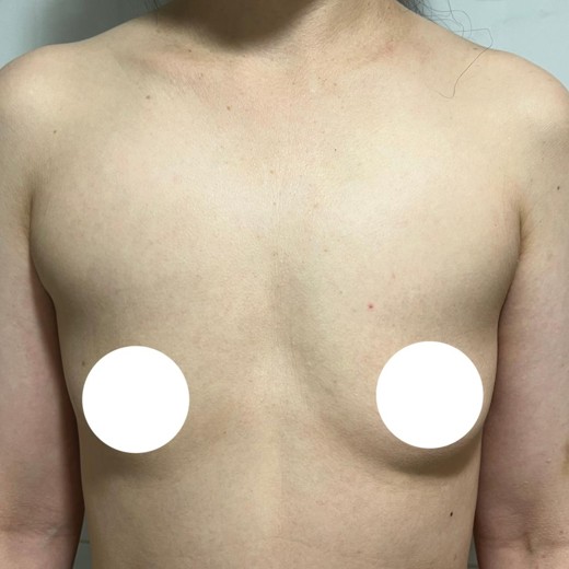 before photo: 가슴(보형물)