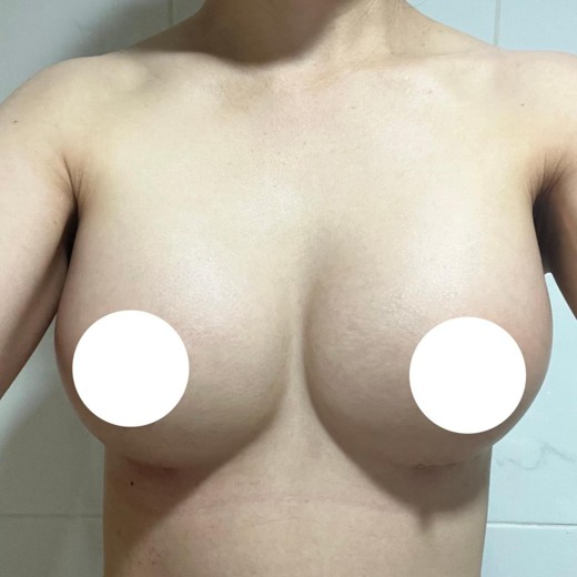 after photo: 가슴(보형물)