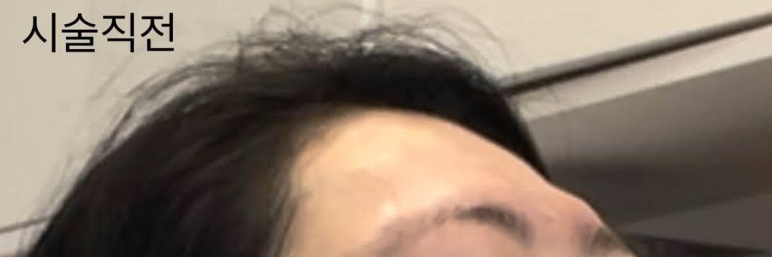 before photo: 이마필러