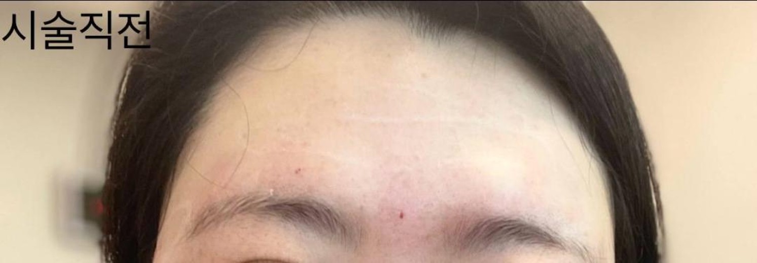before photo: 이마필러