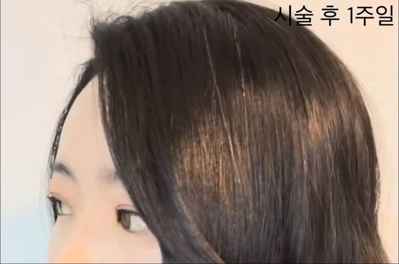 after photo: 이마필러