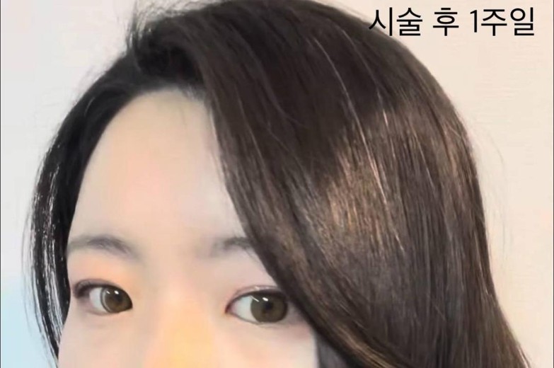 after photo: 이마필러