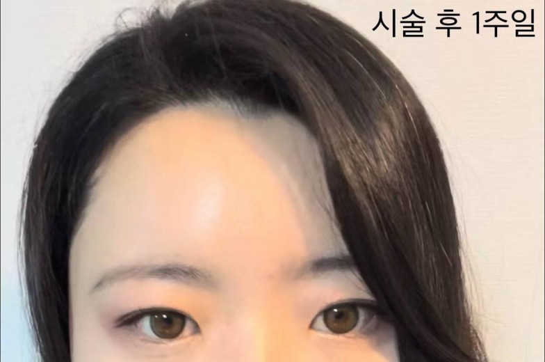 after photo: 이마필러