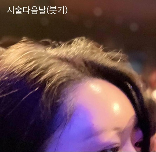 after photo: 이마필러