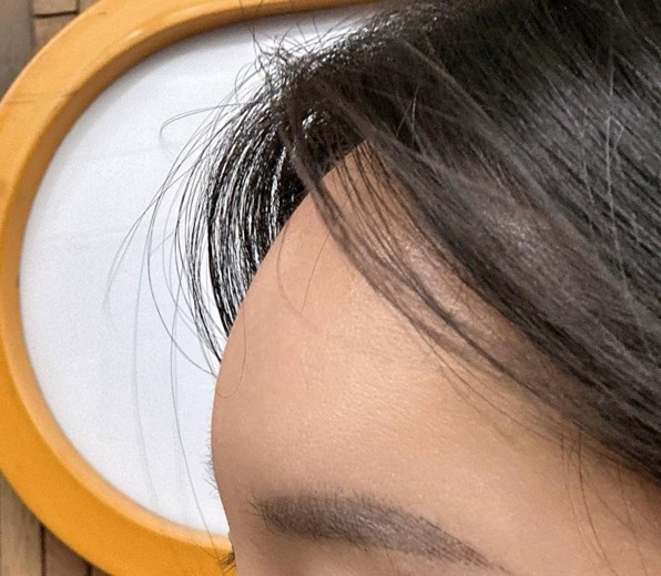 after photo: 이마필러