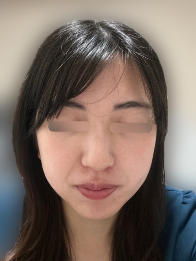 after photo: ミラノリピール