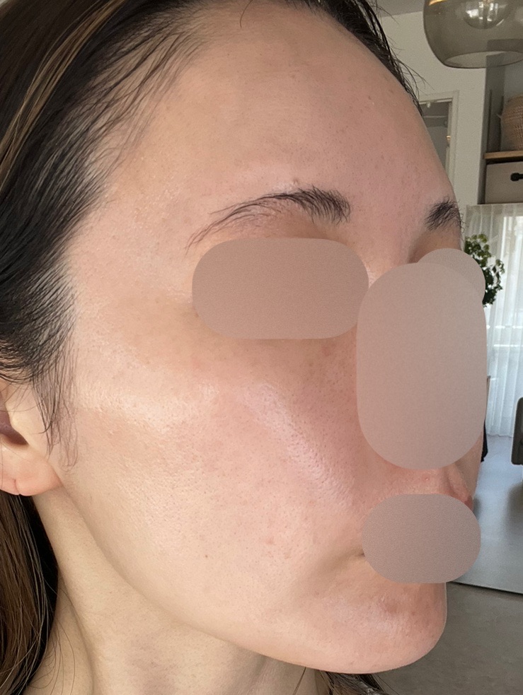 マッサージピール＋エレクトロポーション【再来OK】 | ライズワン美容