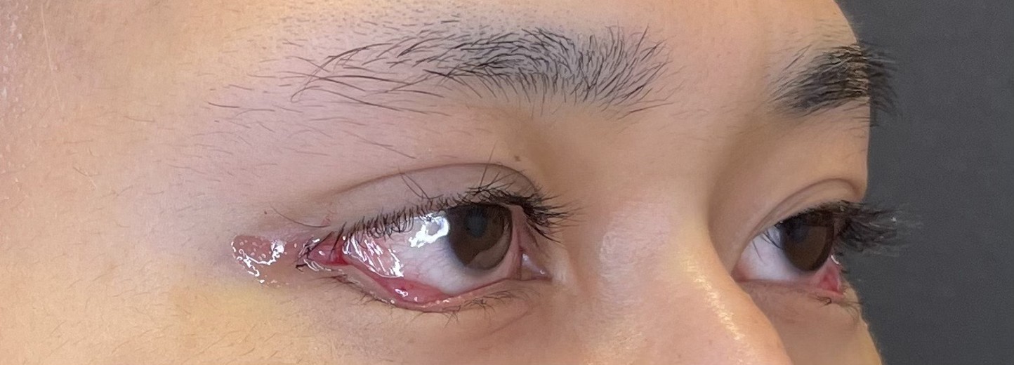 after photo: タレ目形成, 目尻切開