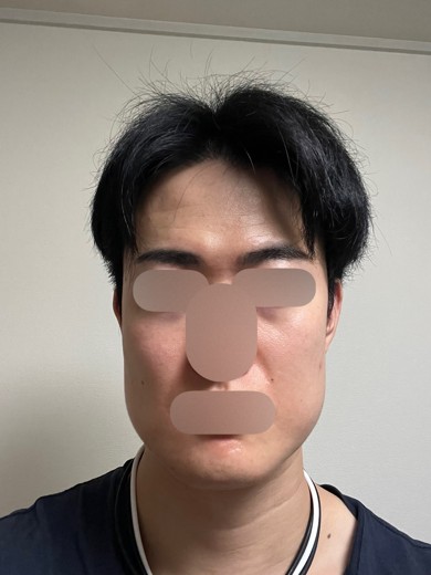 after photo: エレクトロポレーション
