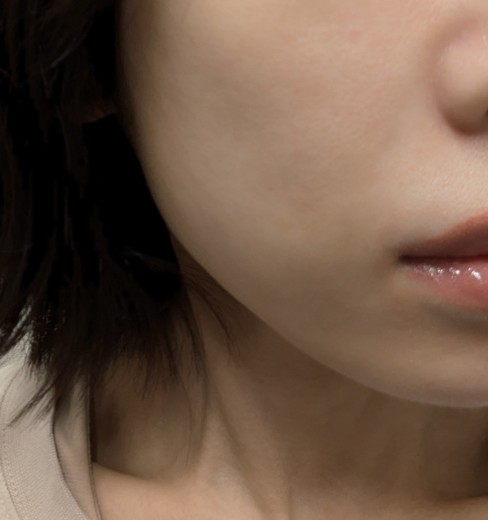 before photo: 糸リフト, メーラー/ジョール/バッカルファット除去