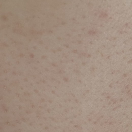 after photo: 아쿠아필링