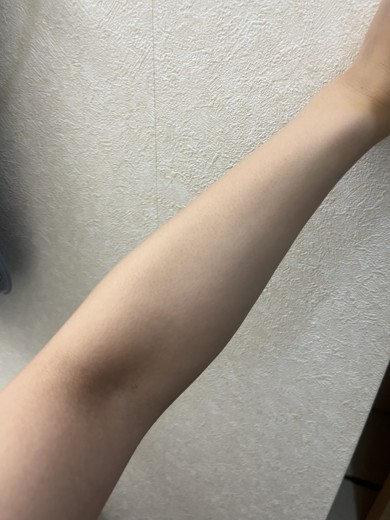 after photo: 白玉注射・点滴