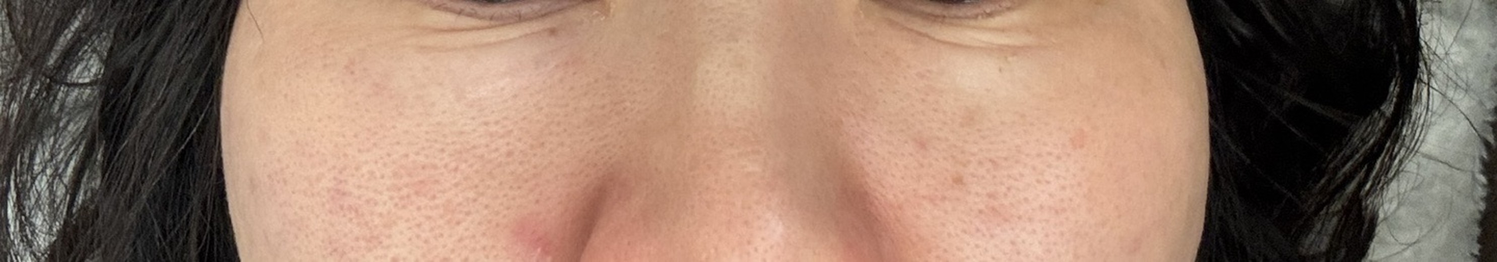 after photo: 리쥬란아이