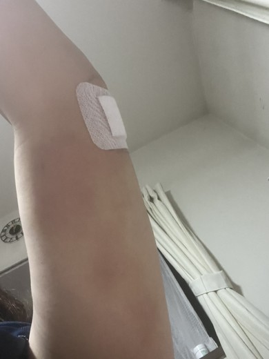 after photo: 脂肪吸引(腕)
