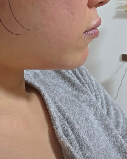 after photo: あごヒアルロン酸