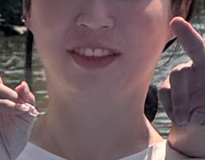 before photo: 콧볼보톡스