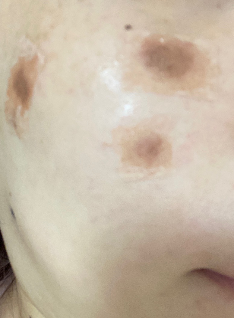 10月15日迄のご予約で初診料0円】全顔シミ取り放題＋美顔