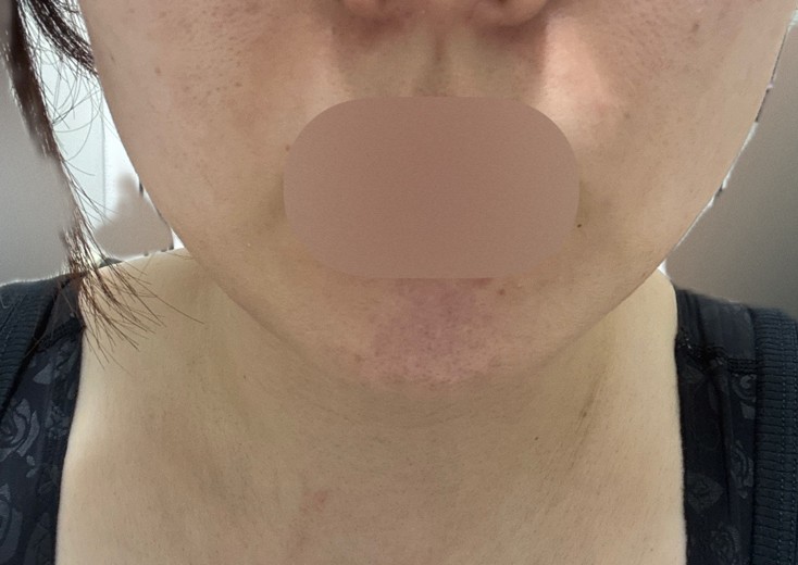 after photo: 脂肪溶解注射(顔)