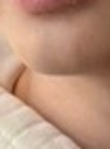 after photo: 턱제모, 인중제모, 아포지레이저