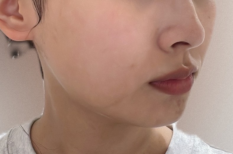 before photo: IPL(光/フォト治療), ルメッカ