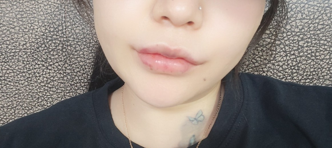 after photo: 이마필러