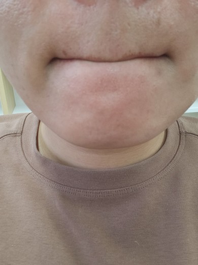 after photo: 아쿠아필링, 수염제모