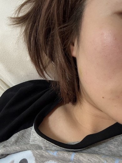 after photo: エラボトックス