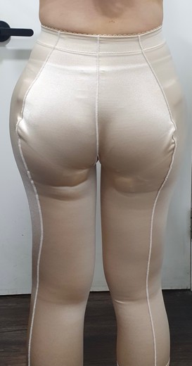 after photo: 허벅지지방흡입