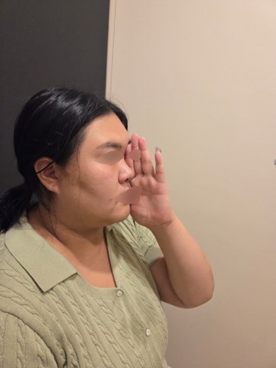 before photo: 비중격만곡증수술, 코끝(보형물)