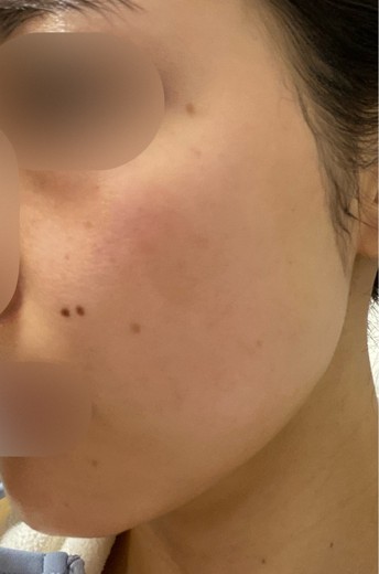 after photo: エレクトロポレーション