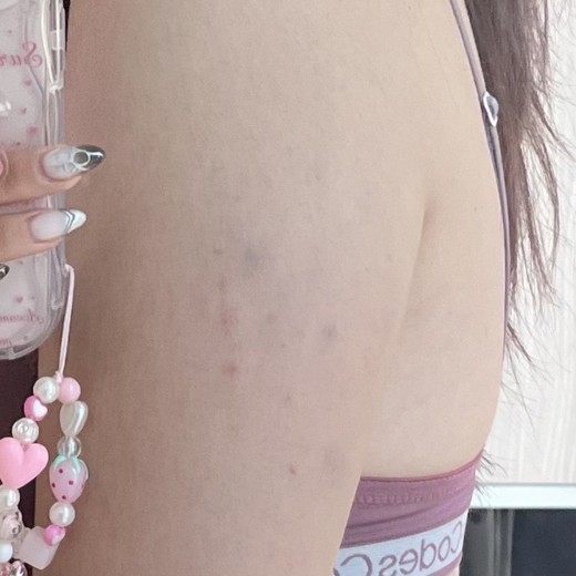 after photo: 팔지방분해주사