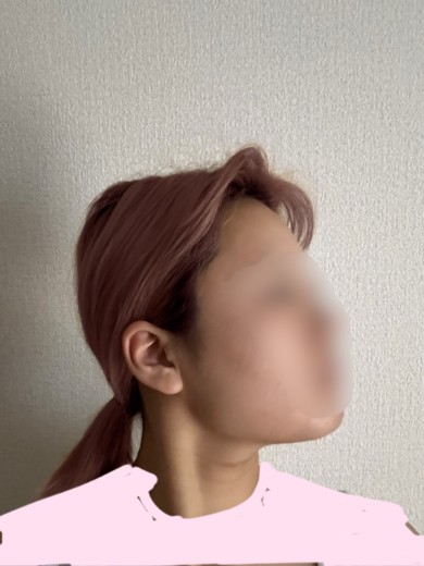 after photo: インモード