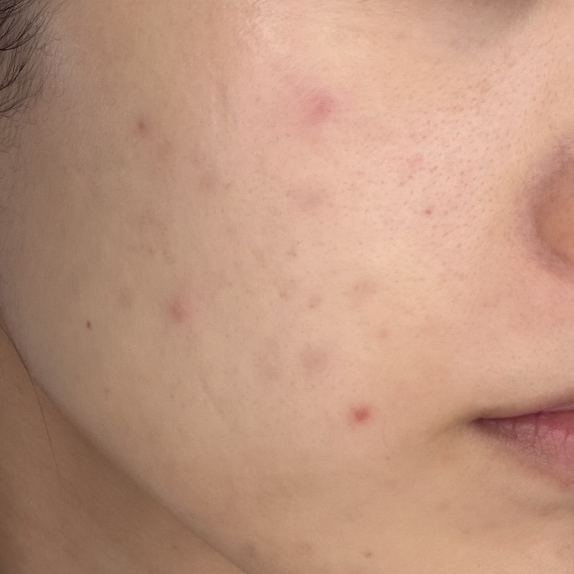 全顔ケミカルピーリング＋顔脱毛セット【3月15日迄にご予約頂いた方