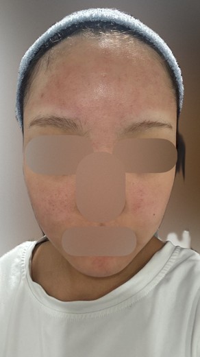 after photo: ダーマペン