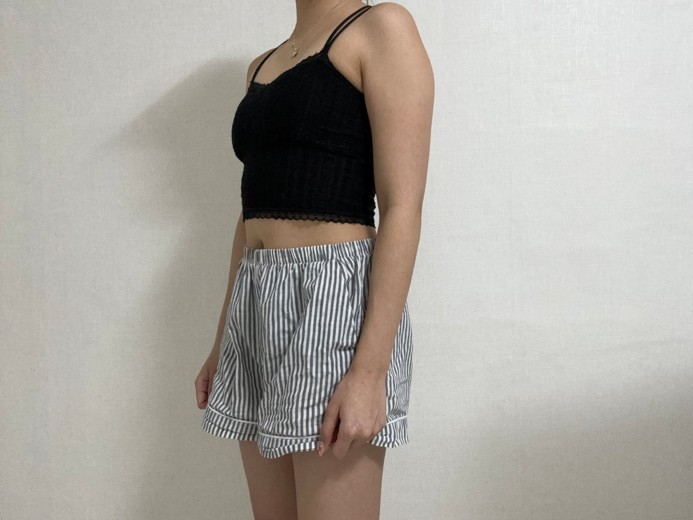 before photo: 팔지방흡입, 부유방흡입