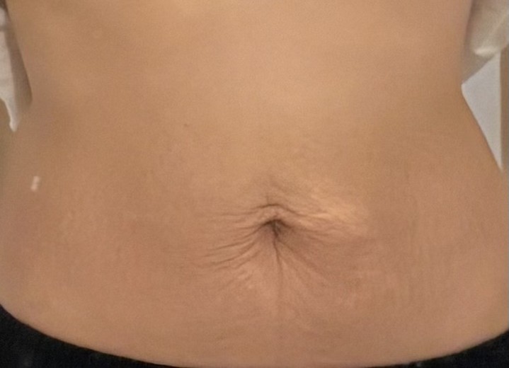 before photo: 脂肪吸引(腹部)